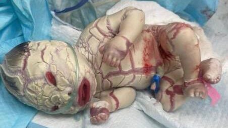 ولادة طفل بجلد “سمكة” في ديالى.. ثالث حالة نادرة من “السماك” تسجل في العراق